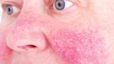 Photo of Káva a rosacea/ružovka: Môže čierny mok pomôcť?