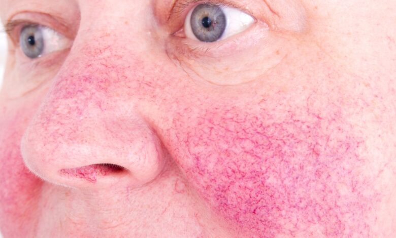 káva a rosacea