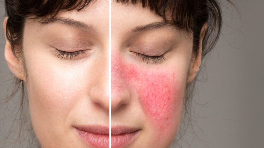 káva a rosacea - čistá tvár a tvár s ružovkou