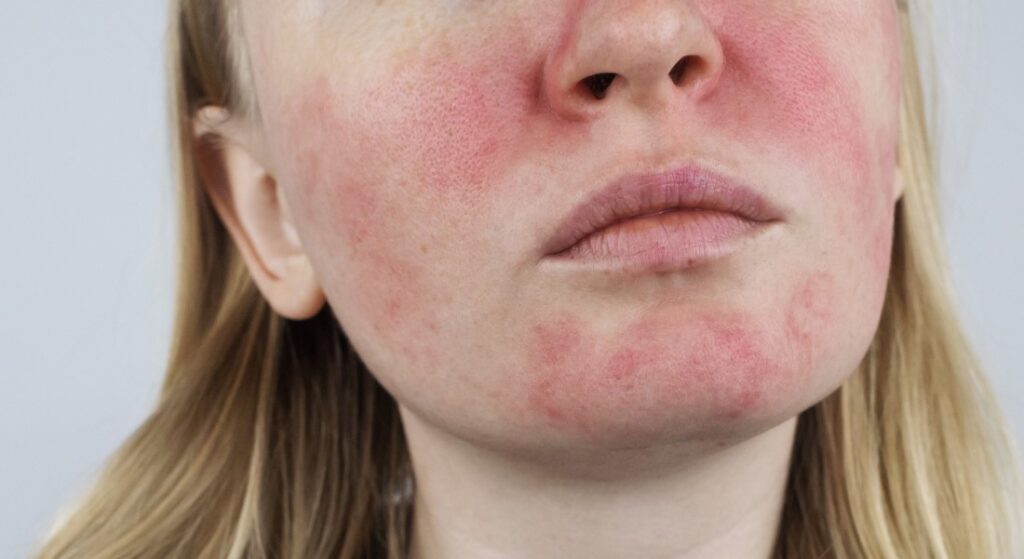 rosacea - prejavy na tvári